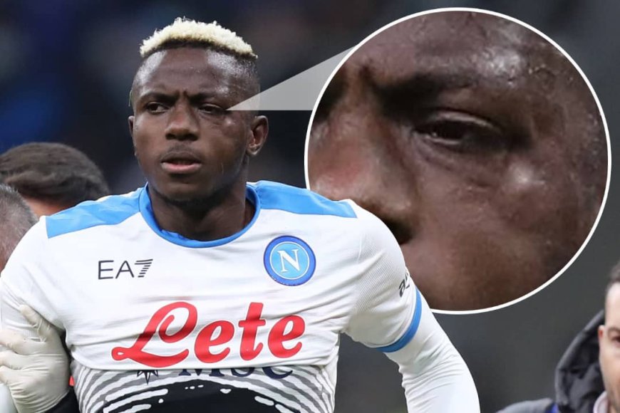 Fractures: Left Side of My Face No Longer Works Properly - Osimhen Reveals Lasting Facial Damage From 2021 Injury